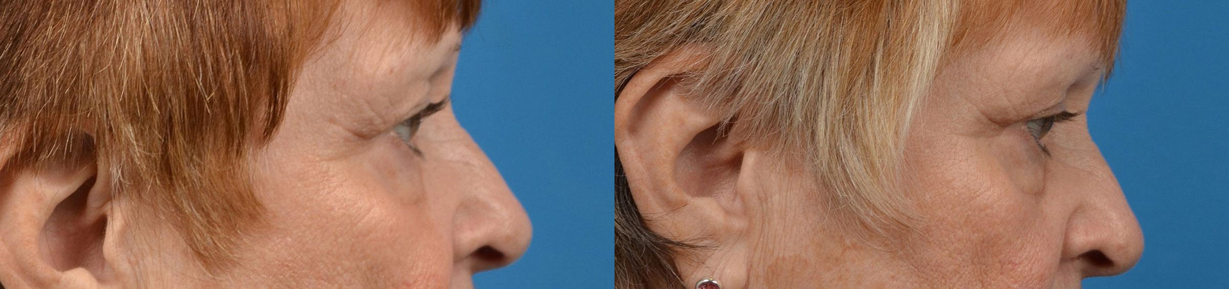 Eyelid Surgery Before & After Gallery - Patient 207469 - Image 3