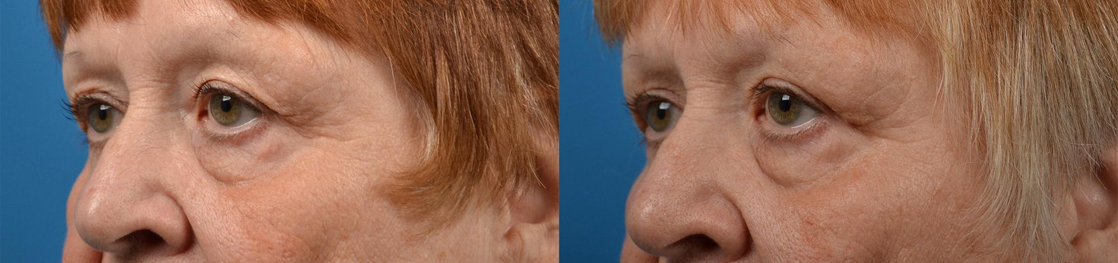 Eyelid Surgery Before & After Gallery - Patient 122444555 - Image 4