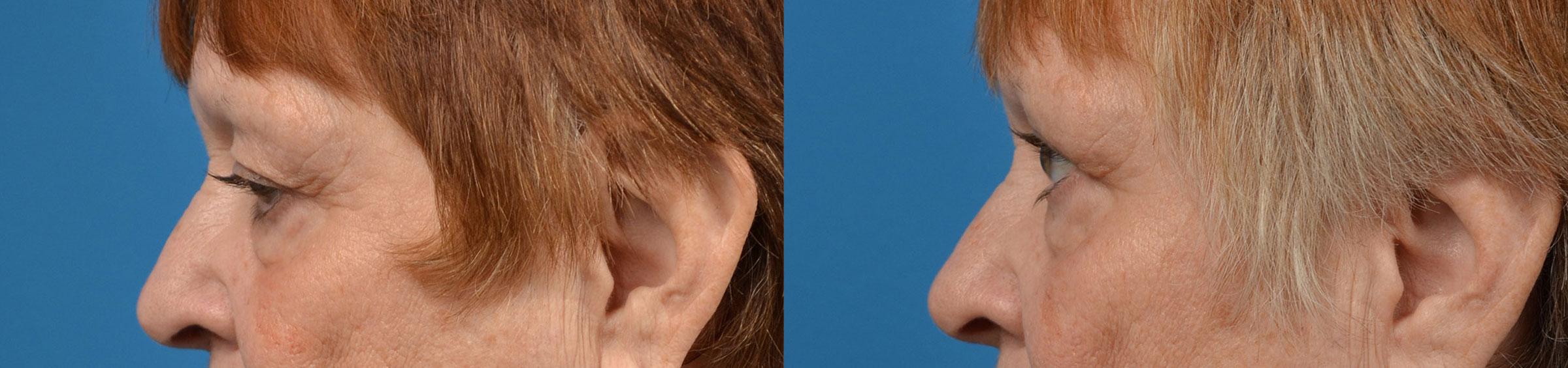 Eyelid Surgery Before & After Gallery - Patient 207469 - Image 5