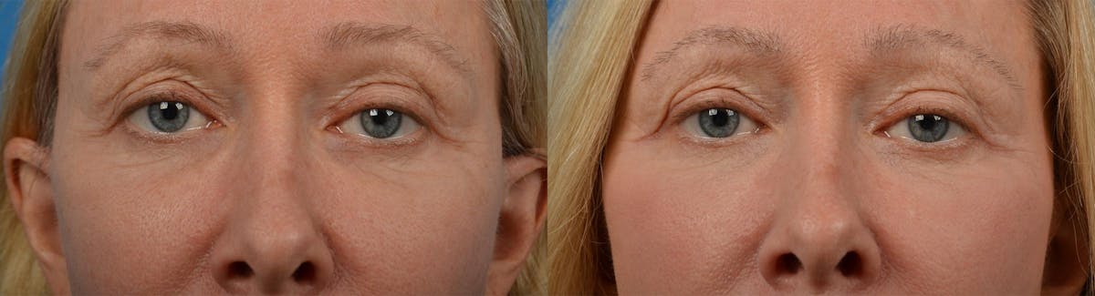 Eyelid Surgery Before & After Gallery - Patient 122444561 - Image 1