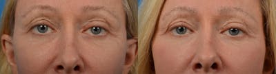 Eyelid Surgery Before & After Gallery - Patient 122444561 - Image 1
