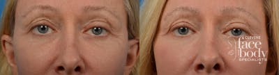 Eyelid Surgery Before & After Gallery - Patient 326054 - Image 1
