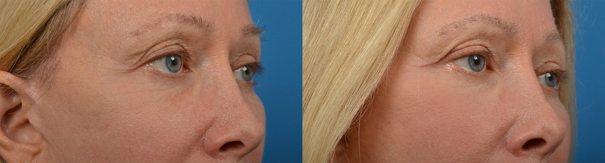 Eyelid Surgery Before & After Gallery - Patient 326054 - Image 2