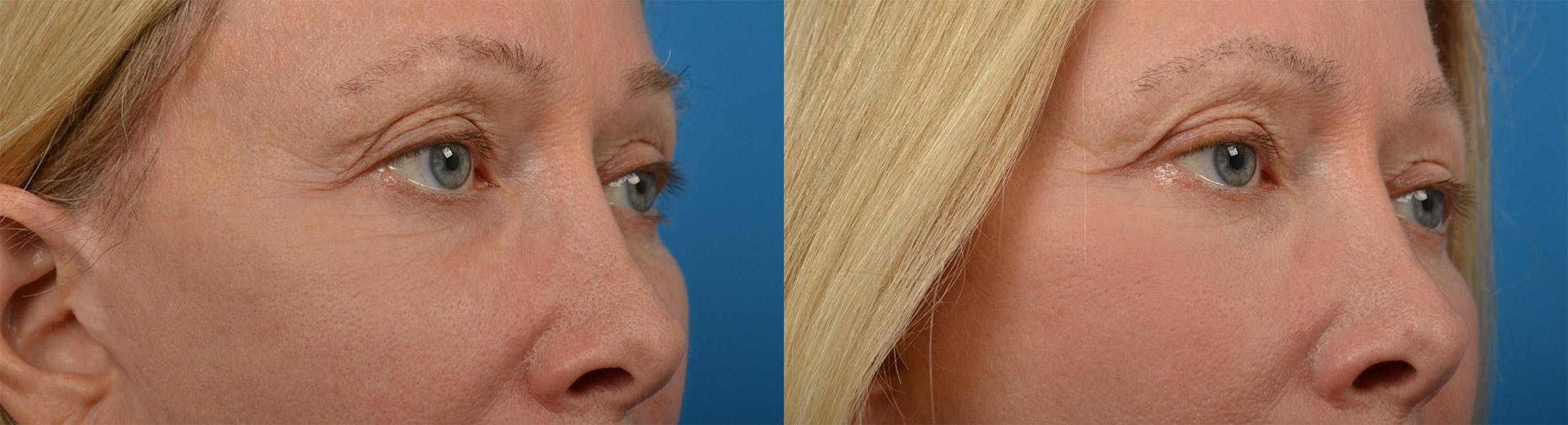 Eyelid Surgery Before & After Gallery - Patient 122444561 - Image 2