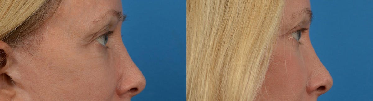 Eyelid Surgery Before & After Gallery - Patient 122444561 - Image 3