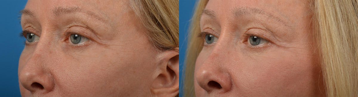 Eyelid Surgery Before & After Gallery - Patient 122444561 - Image 4