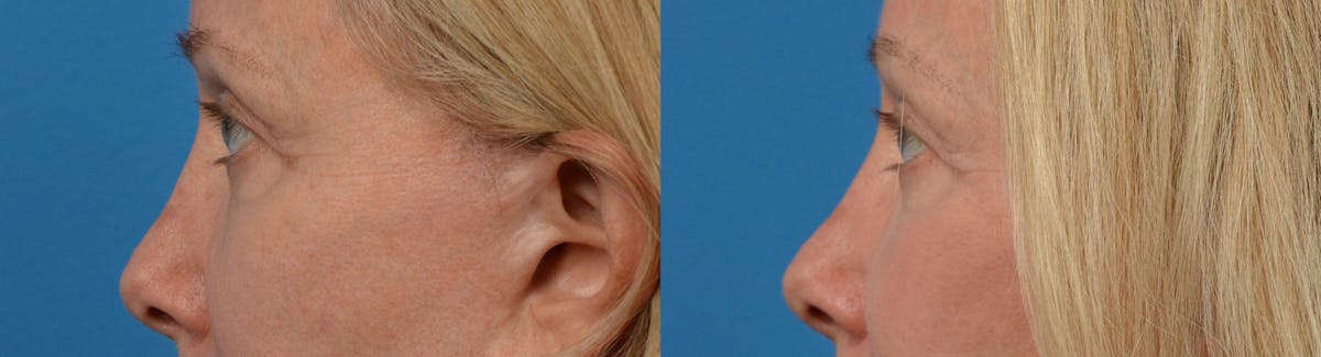 Eyelid Surgery Before & After Gallery - Patient 122444561 - Image 5