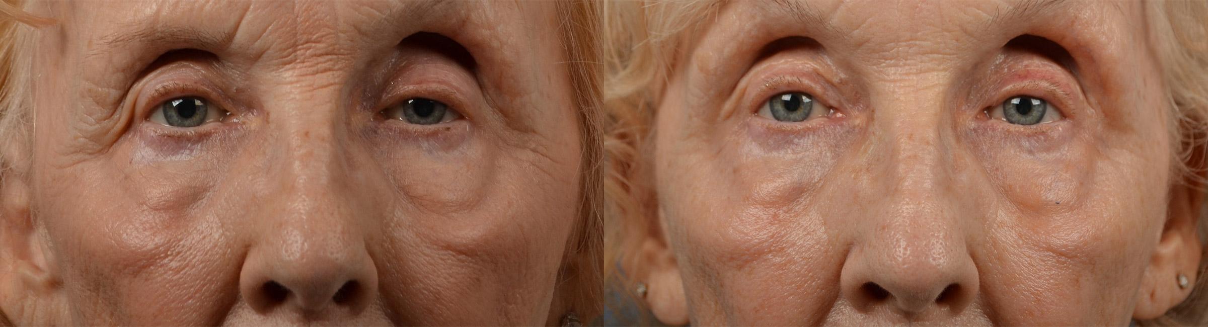 Eyelid Surgery Before & After Gallery - Patient 346831 - Image 1