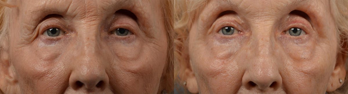 Eyelid Surgery Before & After Gallery - Patient 122444564 - Image 1