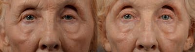 Eyelid Surgery Before & After Gallery - Patient 122444564 - Image 1