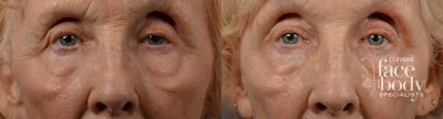 Eyelid Surgery Before & After Gallery - Patient 346831 - Image 1