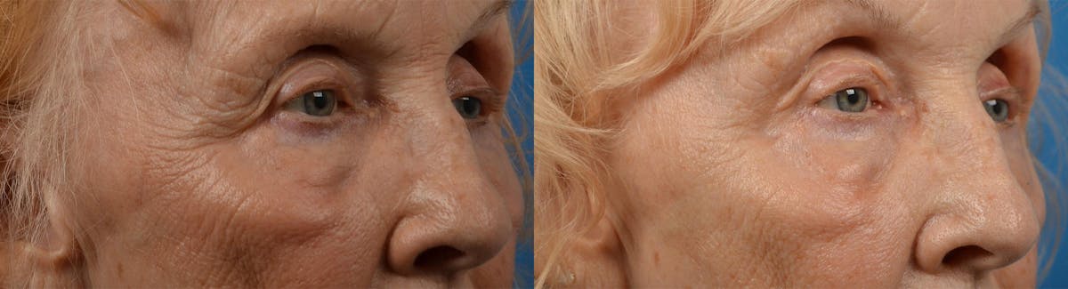 Eyelid Surgery Before & After Gallery - Patient 122444564 - Image 2