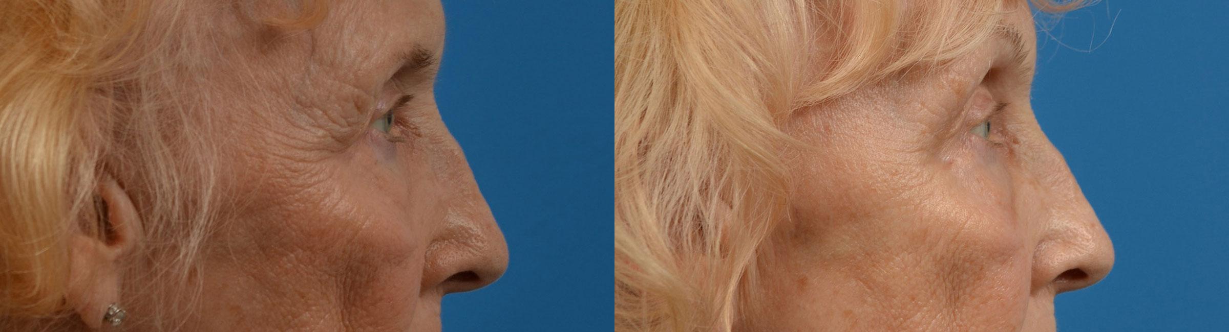 Eyelid Surgery Before & After Gallery - Patient 346831 - Image 3