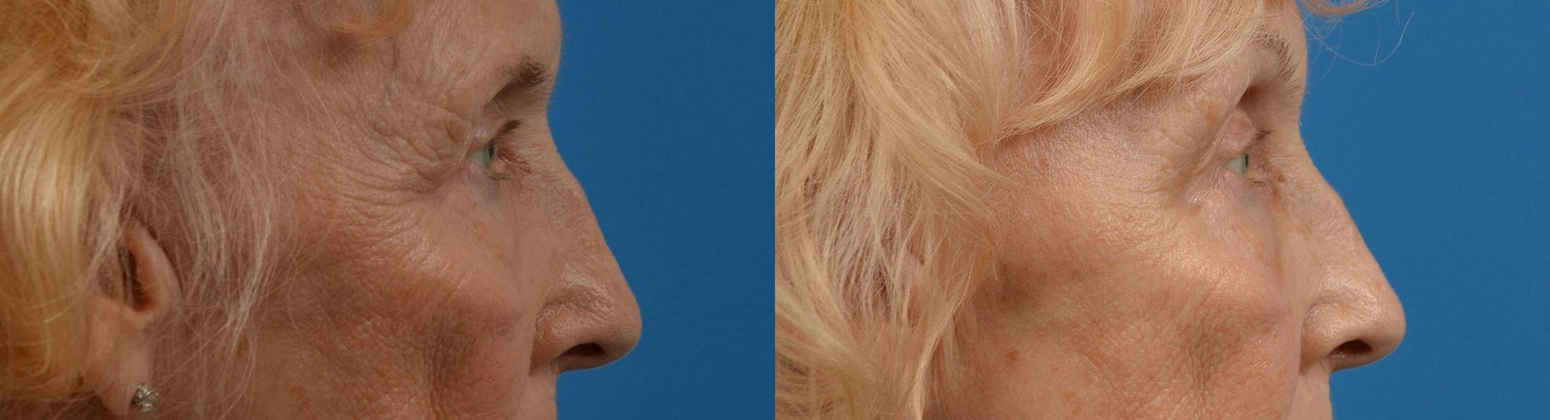 Eyelid Surgery Before & After Gallery - Patient 122444564 - Image 3
