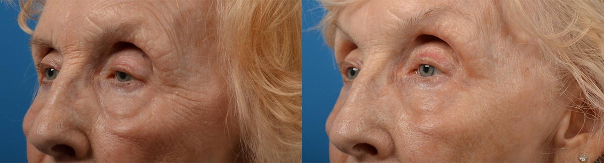 Eyelid Surgery Before & After Gallery - Patient 122444564 - Image 4