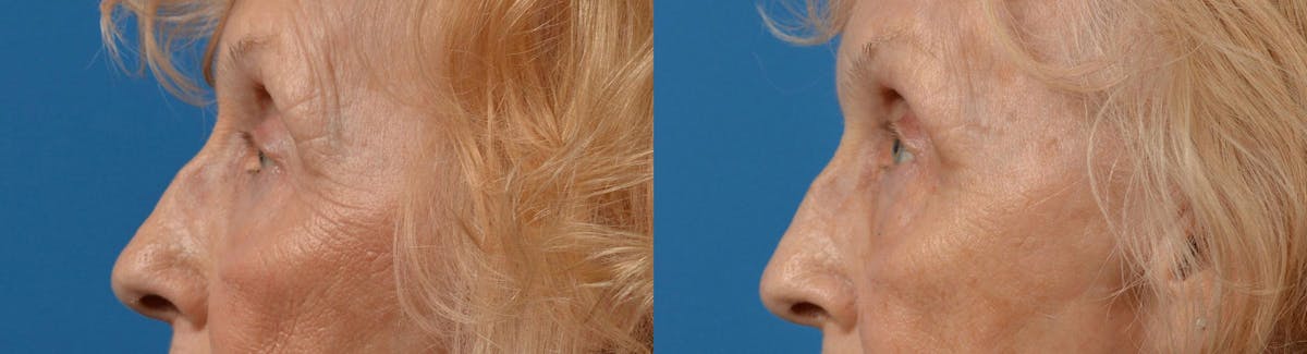 Eyelid Surgery Before & After Gallery - Patient 122444564 - Image 5