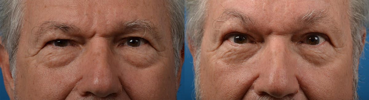 Eyelid Surgery Before & After Gallery - Patient 122444566 - Image 1