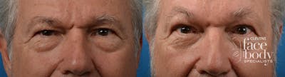 Eyelid Surgery Before & After Gallery - Patient 396661 - Image 1