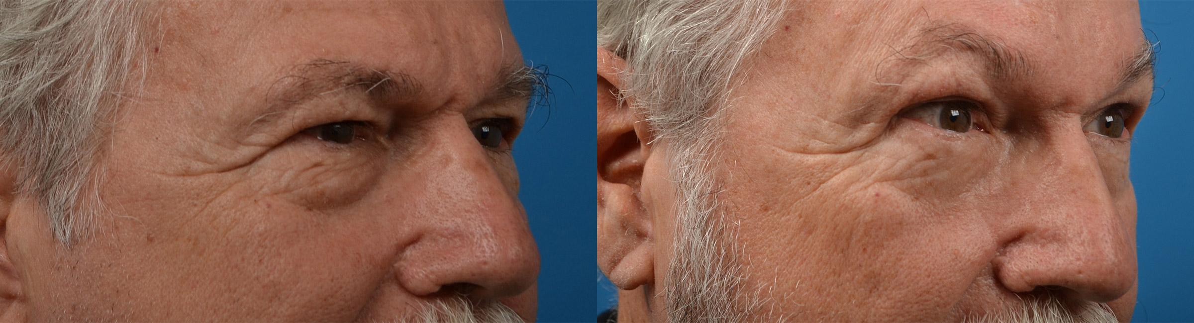 Eyelid Surgery Before & After Gallery - Patient 396661 - Image 2