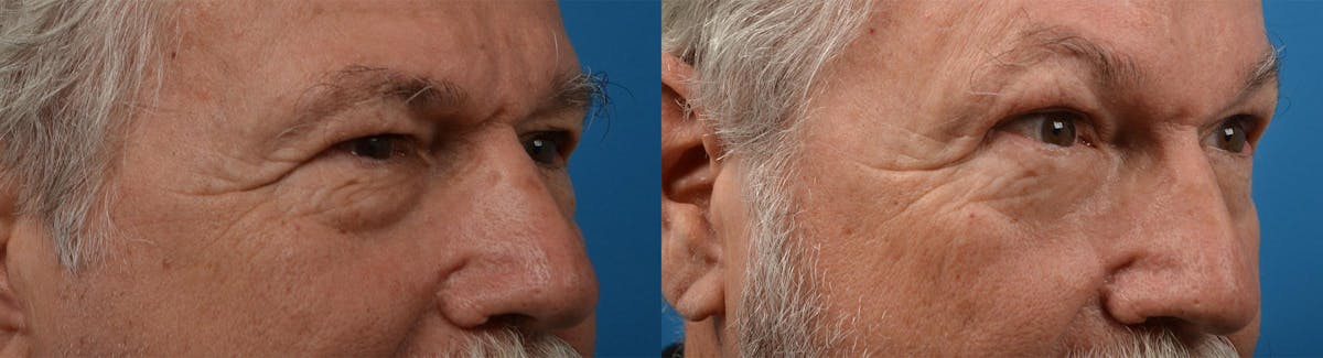 Eyelid Surgery Before & After Gallery - Patient 122444566 - Image 2