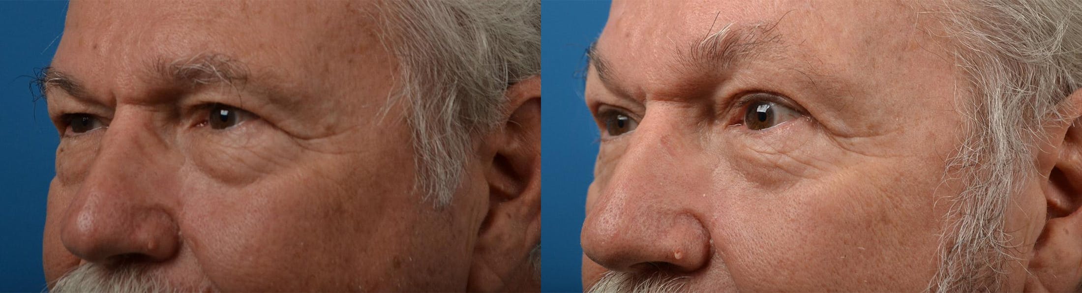 Eyelid Surgery Before & After Gallery - Patient 122444566 - Image 4