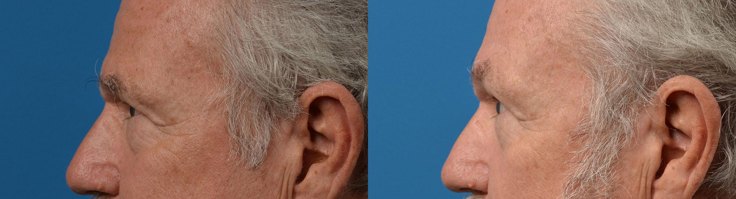 Eyelid Surgery Before & After Gallery - Patient 396661 - Image 5