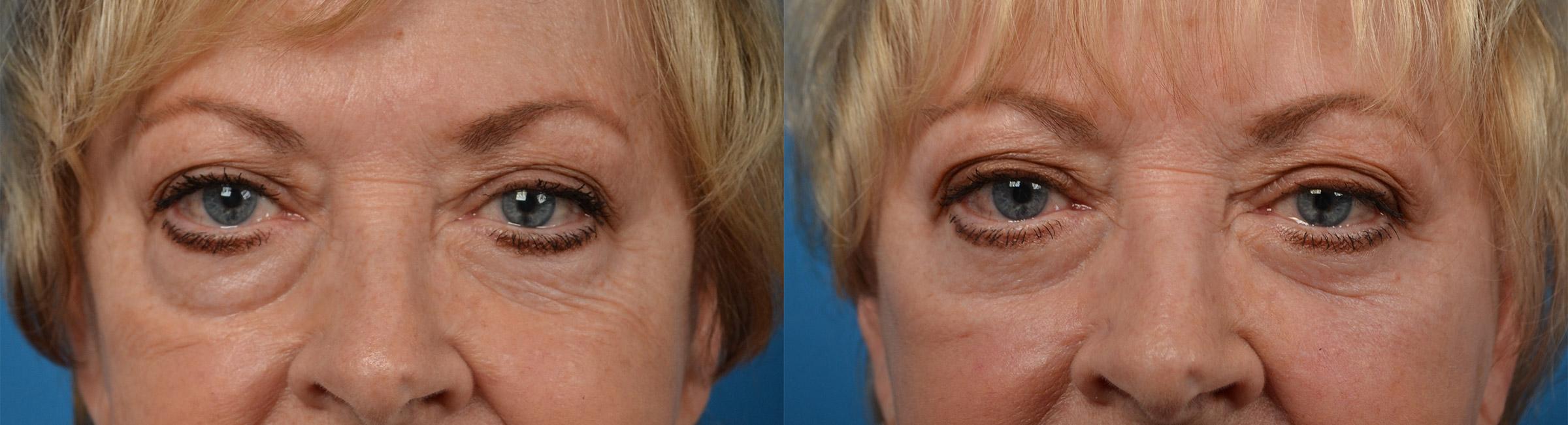 Eyelid Surgery Before & After Gallery - Patient 132503 - Image 1