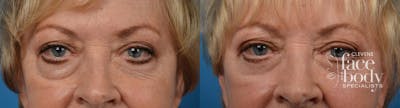 Eyelid Surgery Before & After Gallery - Patient 132503 - Image 1