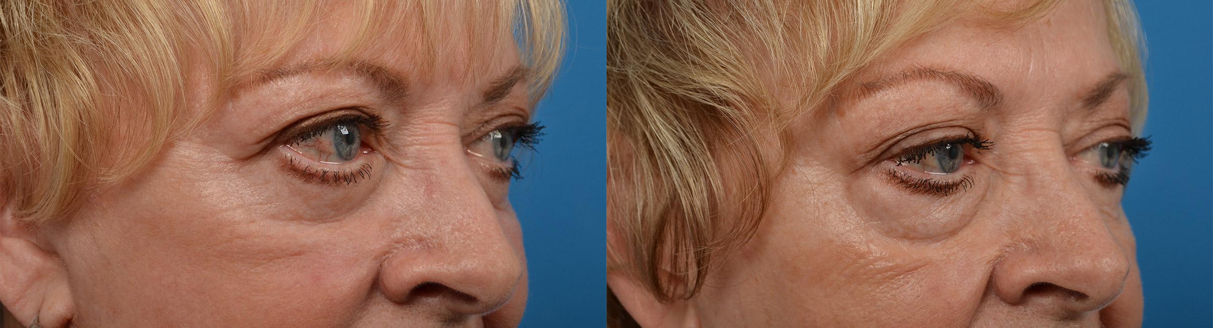 Eyelid Surgery Before & After Gallery - Patient 132503 - Image 2