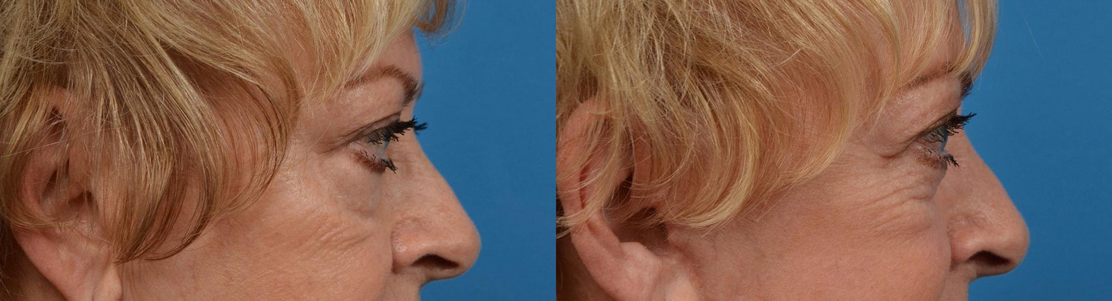 Eyelid Surgery Before & After Gallery - Patient 122444578 - Image 3