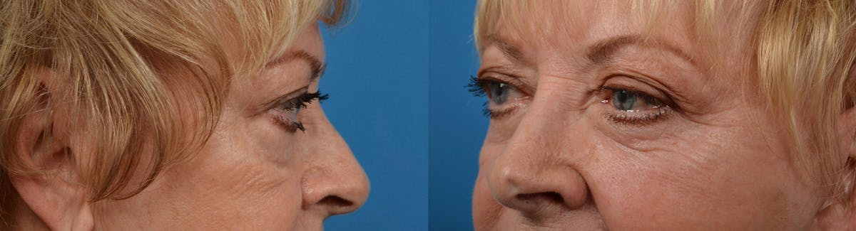 Eyelid Surgery Before & After Gallery - Patient 122444578 - Image 4