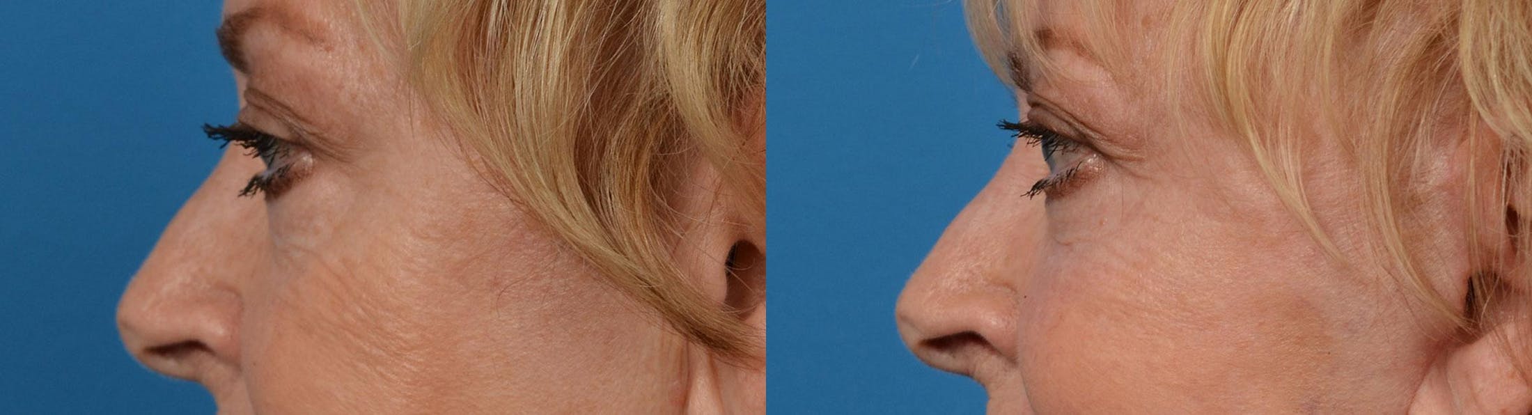 Eyelid Surgery Before & After Gallery - Patient 122444578 - Image 5