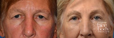 Eyelid Surgery Before & After Gallery - Patient 732174 - Image 1