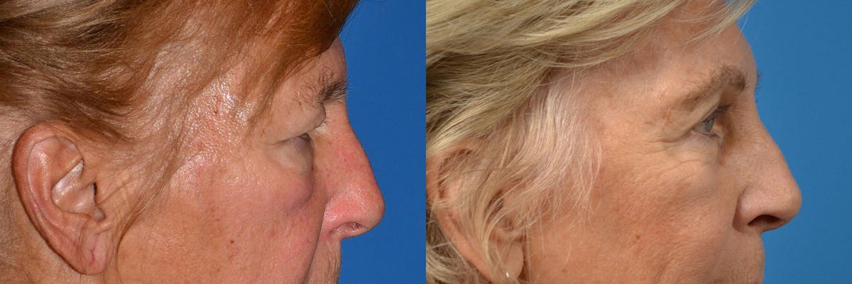 Eyelid Surgery Before & After Gallery - Patient 122444581 - Image 3