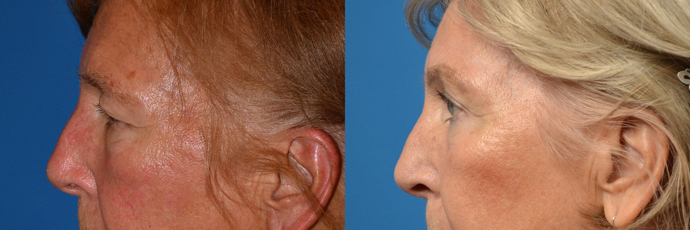 Eyelid Surgery Before & After Gallery - Patient 732174 - Image 5