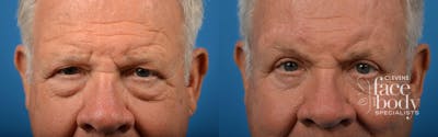 Eyelid Surgery Before & After Gallery - Patient 175365 - Image 1