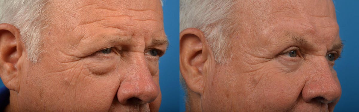 Eyelid Surgery Before & After Gallery - Patient 122444583 - Image 2