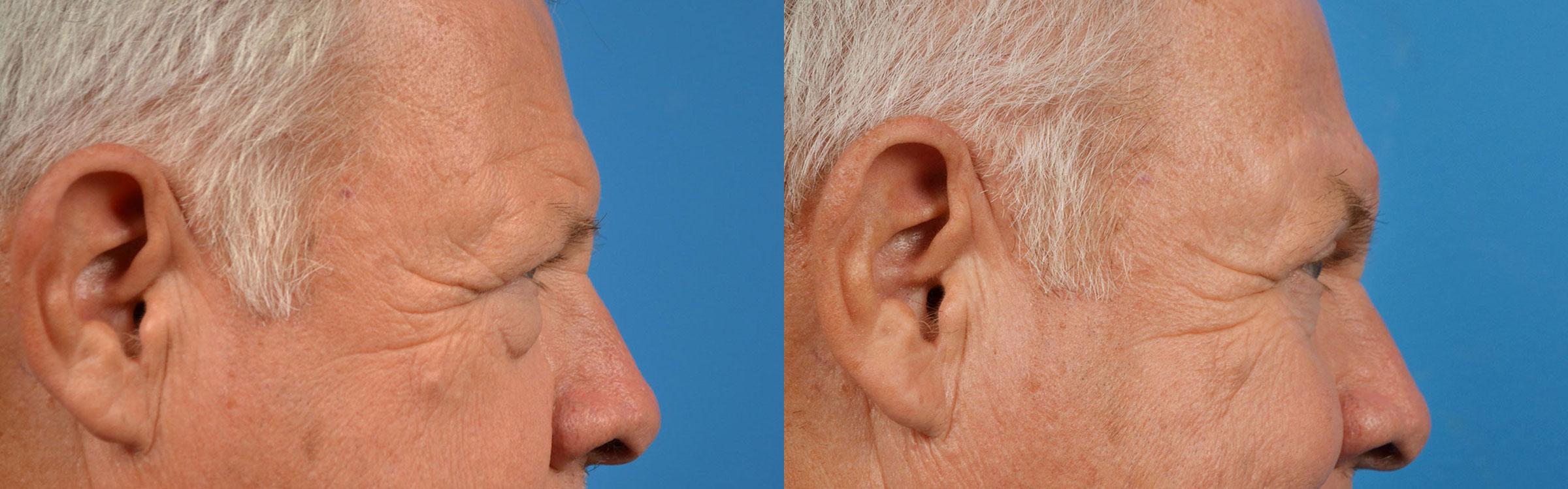 Eyelid Surgery Before & After Gallery - Patient 175365 - Image 3