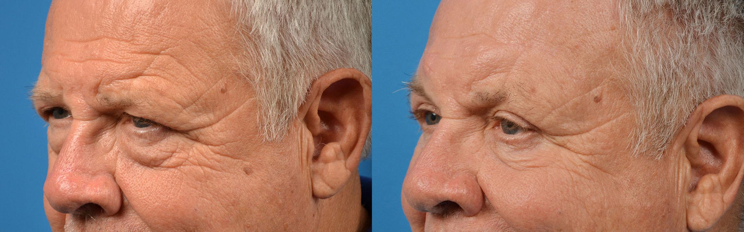 Eyelid Surgery Before & After Gallery - Patient 175365 - Image 4