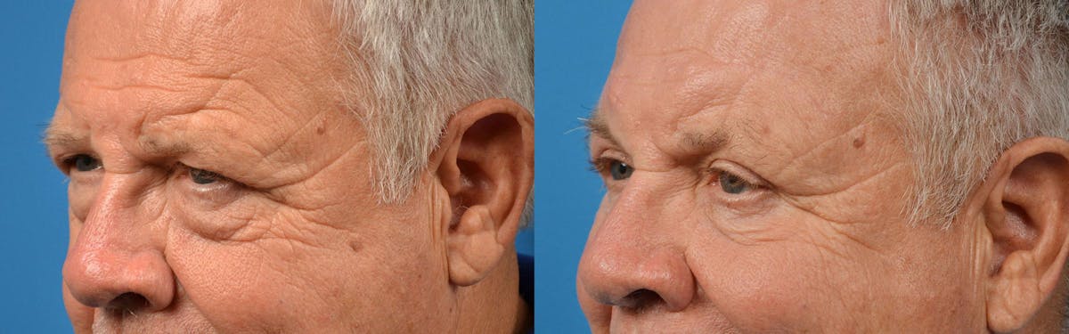 Eyelid Surgery Before & After Gallery - Patient 122444583 - Image 4