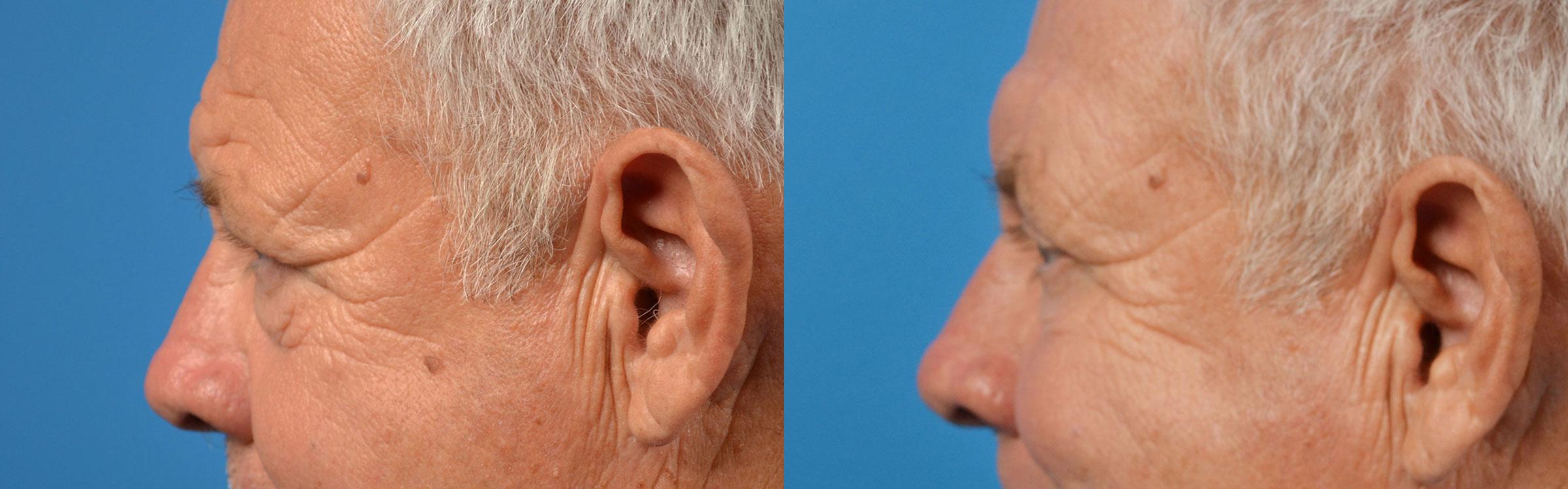 Eyelid Surgery Before & After Gallery - Patient 175365 - Image 5