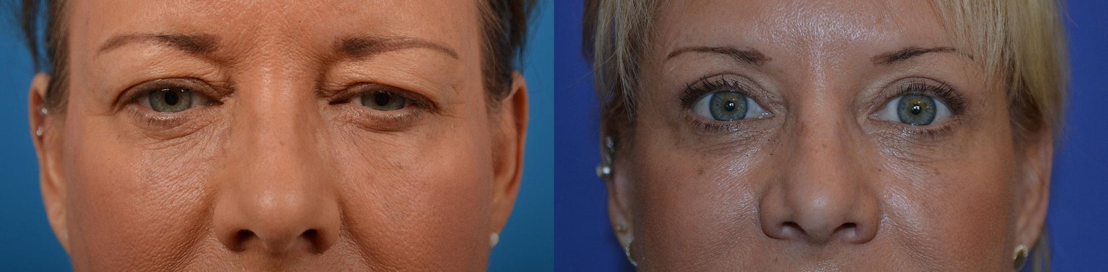 Eyelid Surgery Before & After Gallery - Patient 122444587 - Image 1
