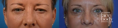 Eyelid Surgery Before & After Gallery - Patient 212214 - Image 1