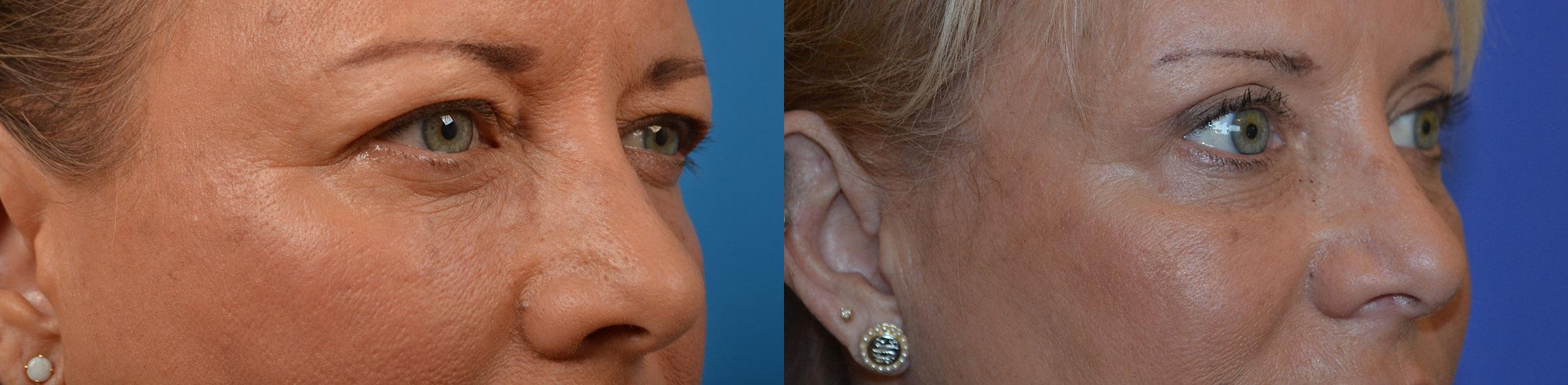 Eyelid Surgery Before & After Gallery - Patient 212214 - Image 2