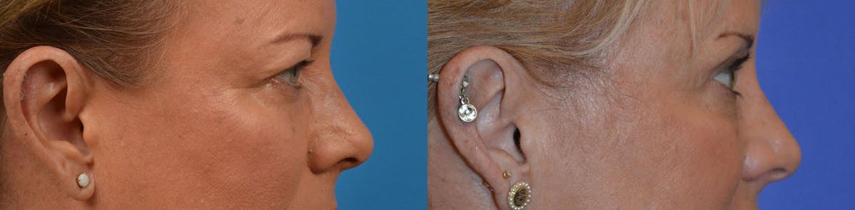 Eyelid Surgery Before & After Gallery - Patient 122444587 - Image 3