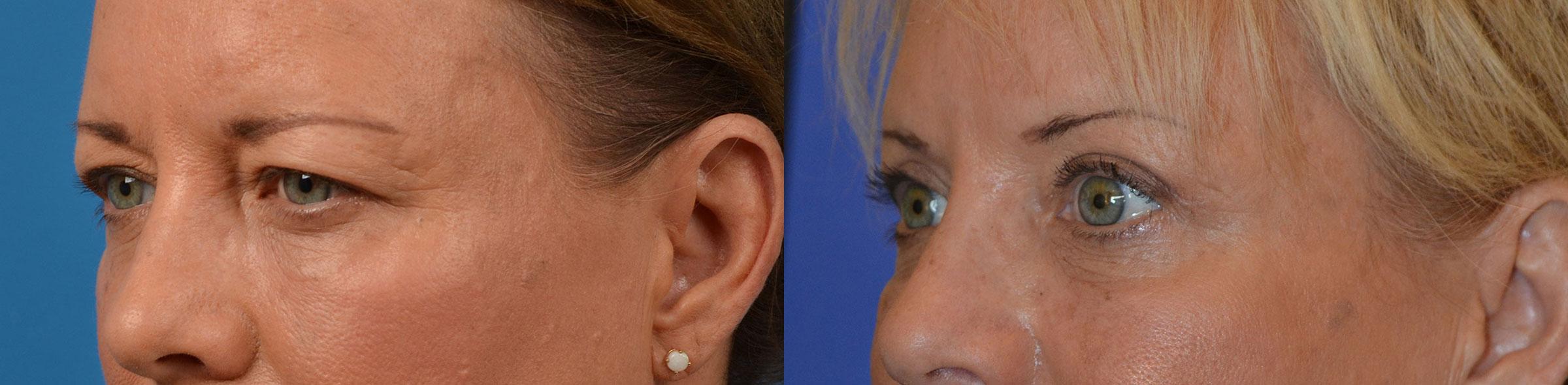 Eyelid Surgery Before & After Gallery - Patient 212214 - Image 4