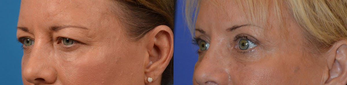 Eyelid Surgery Before & After Gallery - Patient 122444587 - Image 4