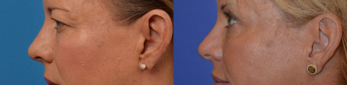 Eyelid Surgery Before & After Gallery - Patient 122444587 - Image 5