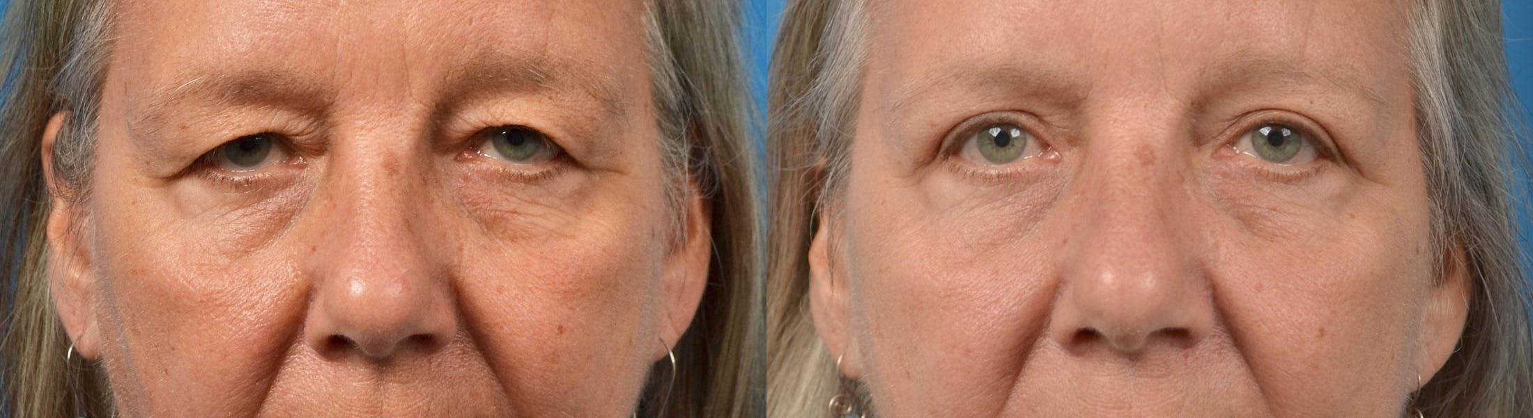 Eyelid Surgery Before & After Gallery - Patient 122444591 - Image 1