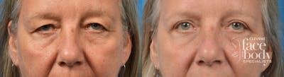 Eyelid Surgery Before & After Gallery - Patient 250985 - Image 1